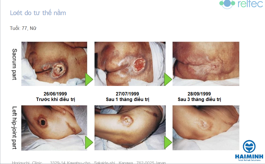 Bệnh nhân loét do tư thế nằm
